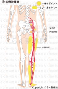 坐骨神経痛