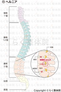 ヘルニア